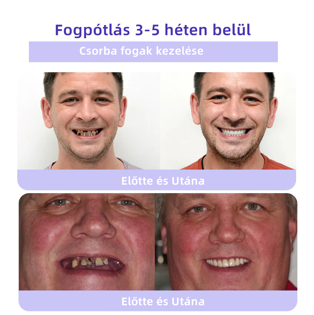 (🔥 Különleges ajánlat utolsó napja - 70% kedvezmény🔥) Spzv™ Fogászati helyreállító ásványi por 🦷 (MOK ajánlásával)