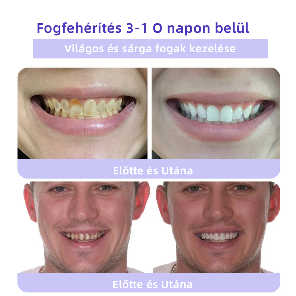 (🔥 Különleges ajánlat utolsó napja - 70% kedvezmény🔥) Spzv™ Fogászati helyreállító ásványi por 🦷 (MOK ajánlásával)